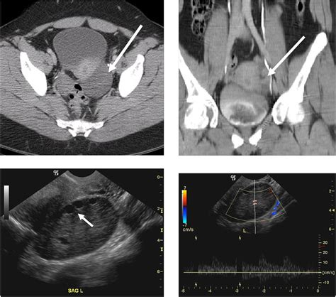 sensitivity of ovarian torsion